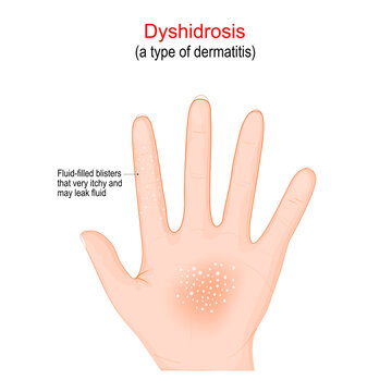 Dyshidrosis. type of dermatitis with itchy blisters on the palms