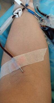 Needle In The Arm Of The Generous Blood Donor During The Blood Transfusion