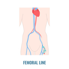 Femoral vein central venous access site shown on male body. Man with femoral central line catheter for hemodialysis, medication and fluids infusion. Medical vector illustration. - obrazy, fototapety, plakaty
