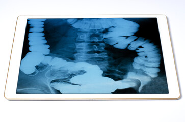 X-ray image of the gastrointestinal tract in a tablet. The concept of telemedicine and diagnosis of diseases