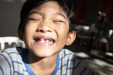Little Southeast Asian boy with dental problems smiling showing his tooth caries and cavities
