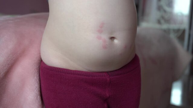 pimples on the abdomen,baby shows belly with pimples