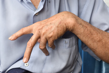 Ulnar claw hand of Asian elder man. also known as 'spinster's claw.