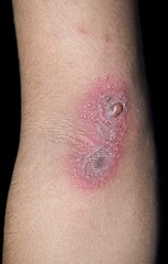 Paederus dermatitis in arm. It is a peculiar, irritant contact one caused by a beetle belonging to...