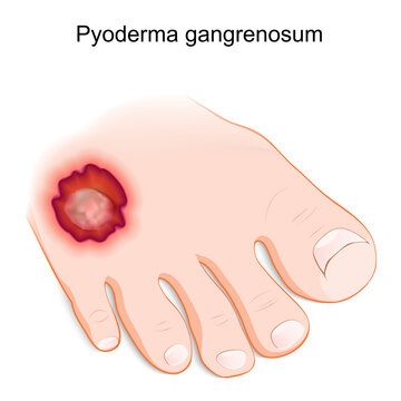 Pyoderma gangrenosum. inflammatory skin disease