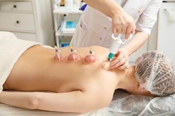 Vacuum massage. Vacuum cups of medical cupping therapy on woman back, close up, chinese medicine.