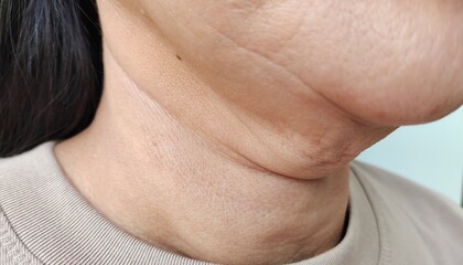 close up portrait the flabbiness adipose hanging under the neck, problem wrinkles and flabby skin under the chin, concept health care. - obrazy, fototapety, plakaty