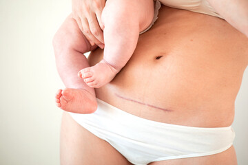 Mom's abdomen after cesarean section. Scar seam. A young mother holds the baby in her arms. Real...