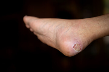 Close Up foot bloody callus on man's heel.