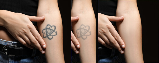Woman before and after laser tattoo removal procedures on black background, closeup. Collage with...