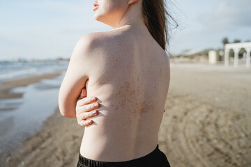 female back with skin rash