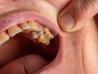 Teeth with caries and pulpous teeth in the mouth of a female patient. Dental treatment in dentistry, close-up