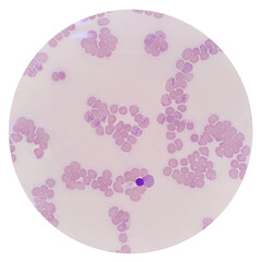 Reticulocyte count under 100x light microscope by using New methylene blue stain and stained again with Wright-Giemsa stain. A reticulocyte stain measures aggregates of residual ribosomes. - obrazy, fototapety, plakaty