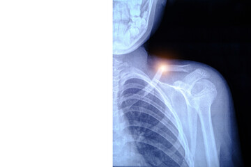 X-ray image broken collarbone person.