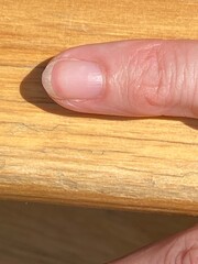 terrys nail is white with red band tip & missing half moon  can be diseases, 