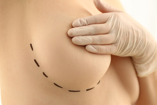 Woman close nipple with hand, linear marking on boob, cosmetic surgery operation