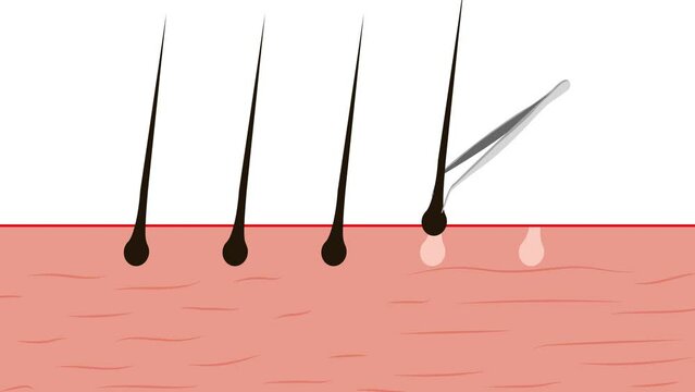 4K animation of a Hair removal concept with a tweezer. Using a tweezer to remove body hair 4K footage. Beauty salon concept with a hand tweezer removing body hair, animated video.