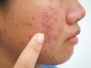 Teenage girl with acne problem on white background. Beauty concept. Closeup photo, blurred.