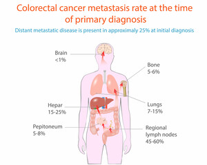 Vector illustration of colorectal cancer metastasis, medical diagram