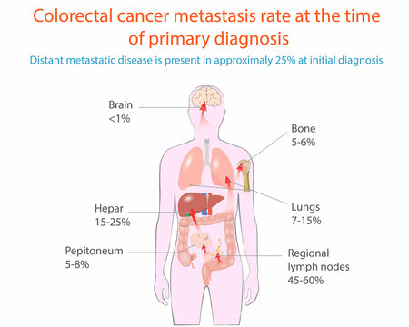 Vector Illustration Of Colorectal Cancer Metastasis, Medical Diagram