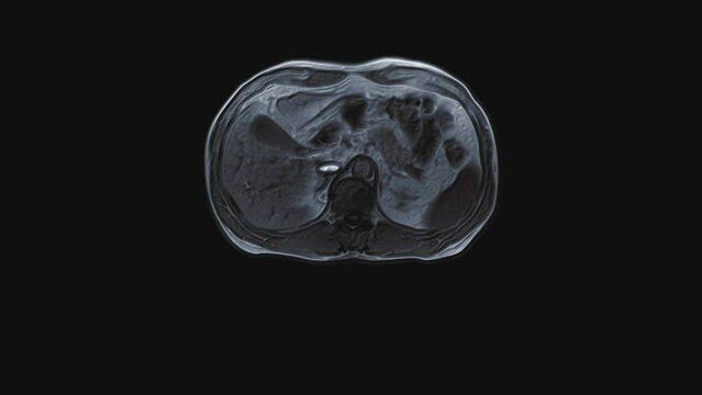 Voluminous color CT scan of the abdomen. Computed tomography of the gastrointestinal tract, liver and kidneys