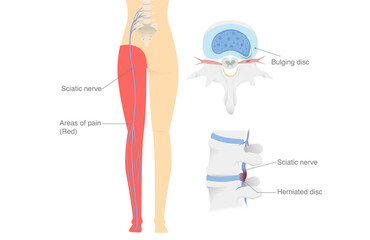 Diagram shows the Sciatica nerve from a herniated disc and trapped nerves make patients pain in the legs and hip areas. Illustration about medical diagram. - obrazy, fototapety, plakaty
