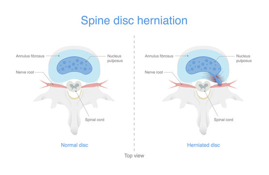 Comparing normal spine and disc herniated people is an injury to the cushioning and connective tissue between vertebrae. Illustration of Medical diagram.