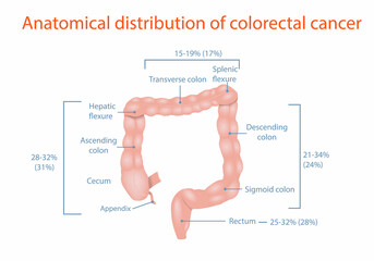 Anatomical distribution of colorectal cancer, medical diagram