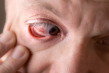 Subconjunctival hemorrhage - hyposphagma. Close up of man's face showing red bloodshot eye.