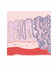 Histology of colorectal carcinoma, vector, medical illustration