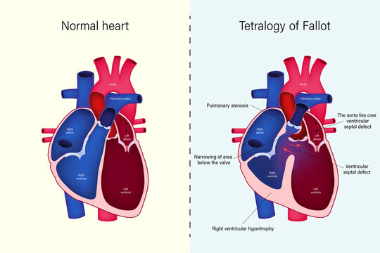 The difference of Normal heart and Tetralogy of Fallot vector. Congenital heart disease.