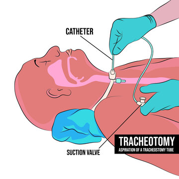 Tracheostomy is an opening in the front of the neck that is made during an emergency procedure or planned surgery.