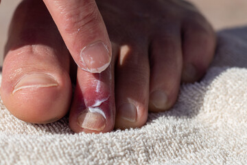Male foot with bruised toe and ointment on the towel.
