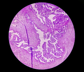 Microscopic image or photomicrograph of Fallopian tube biopsy.