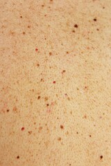 Moles and birthmark on human skin texture. photo vertical full frame