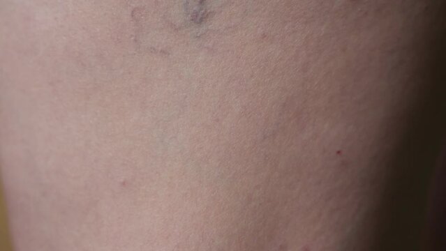 Enlarged varicose veins on old woman leg. Restricted blood flow of aged person. Purple varicose veins twists around elderly lady leg extreme closeup