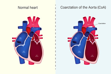 The difference of Normal heart and Coarctation of the Aorta vector. Congenital heart disease. - obrazy, fototapety, plakaty