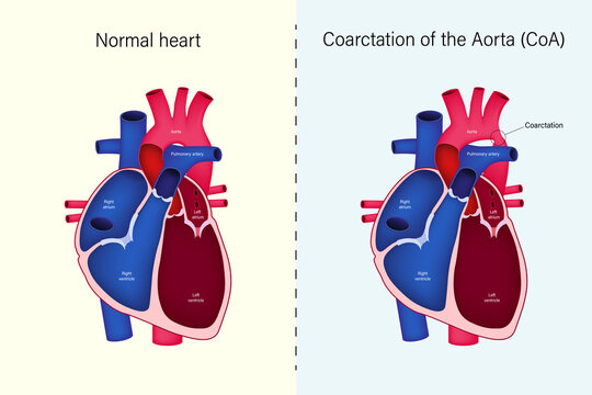 The difference of Normal heart and Coarctation of the Aorta vector. Congenital heart disease.