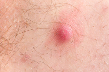 A large red pimple on a person's skin. Inflammation on the skin, acne.