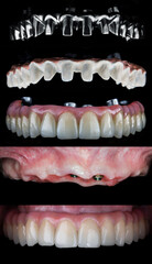 photo collage from the titanium beam to the installed prosthesis of the upper jaw in the oral cavity on a black background