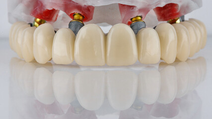 dental prosthesis of the upper jaw on the bar with a model on a white background © Dental Pro Content