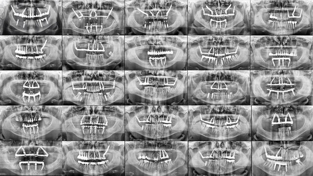 dental collage of different panoramic x-rays with different dental implant settings
