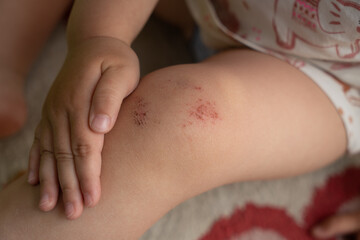 baby carefully holds his hand scratched knee, which is in the wounds from falling on the asphalt, todler's first injury from falling, beaten knee touching photos taken in sunny weather