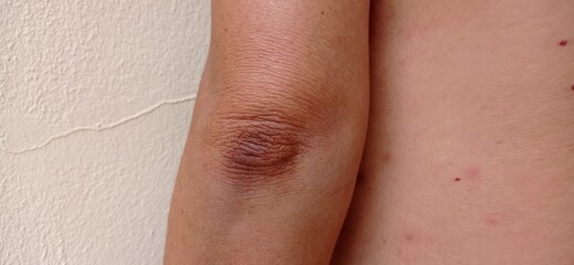 Dark skin of men's elbows.