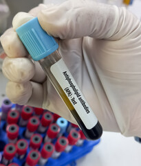 Blood sample tube for Antiphospholipid antibodies(APA) test. To diagnosis Antiphospholipid Syndrome, Connective Tissue Diseases. - obrazy, fototapety, plakaty
