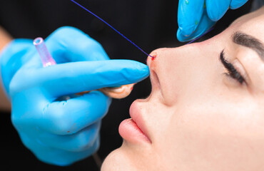 Cosmetic procedure for non-surgical rhinoplasty. The beautician inserts cosmetic threads into the...