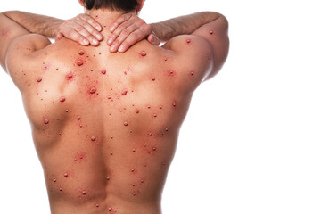 Male back affected by blistering rash because of monkeypox or other viral infection - obrazy, fototapety, plakaty