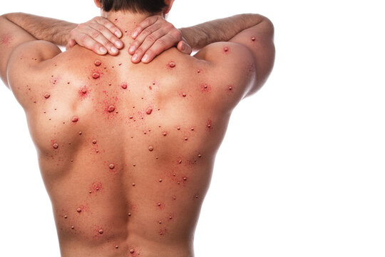 Male back affected by blistering rash because of monkeypox or other viral infection