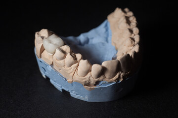 Mold of teeth. Gypsum model plaster of teeth. Stomatologic plaster cast, molds of human jaws and teeth on black background. Dentistry and orthodontics concept.
