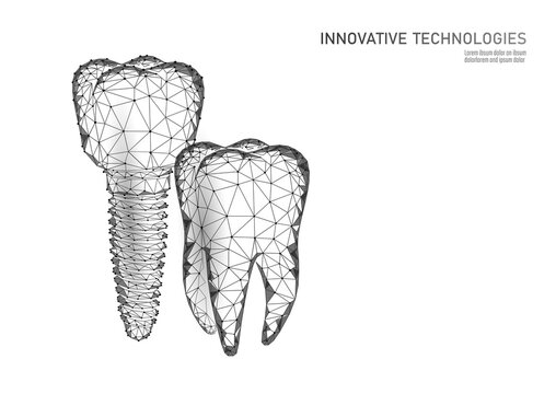 Molar tooth dental implant 3d low poly geometric model. Dentistry innovation future technology titan metal thread. Medical healthy science blue polygonal point line vector illustration